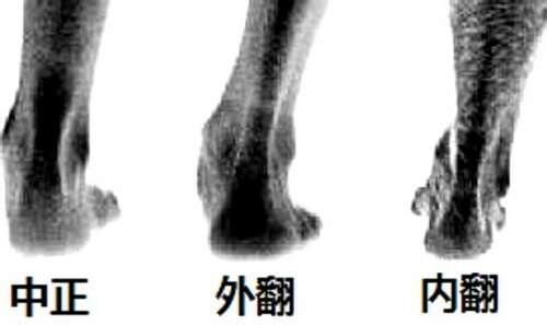 内外翻  第2张